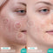 Before and after image of woman using Salicylic Acid & Sea Kelp Serum