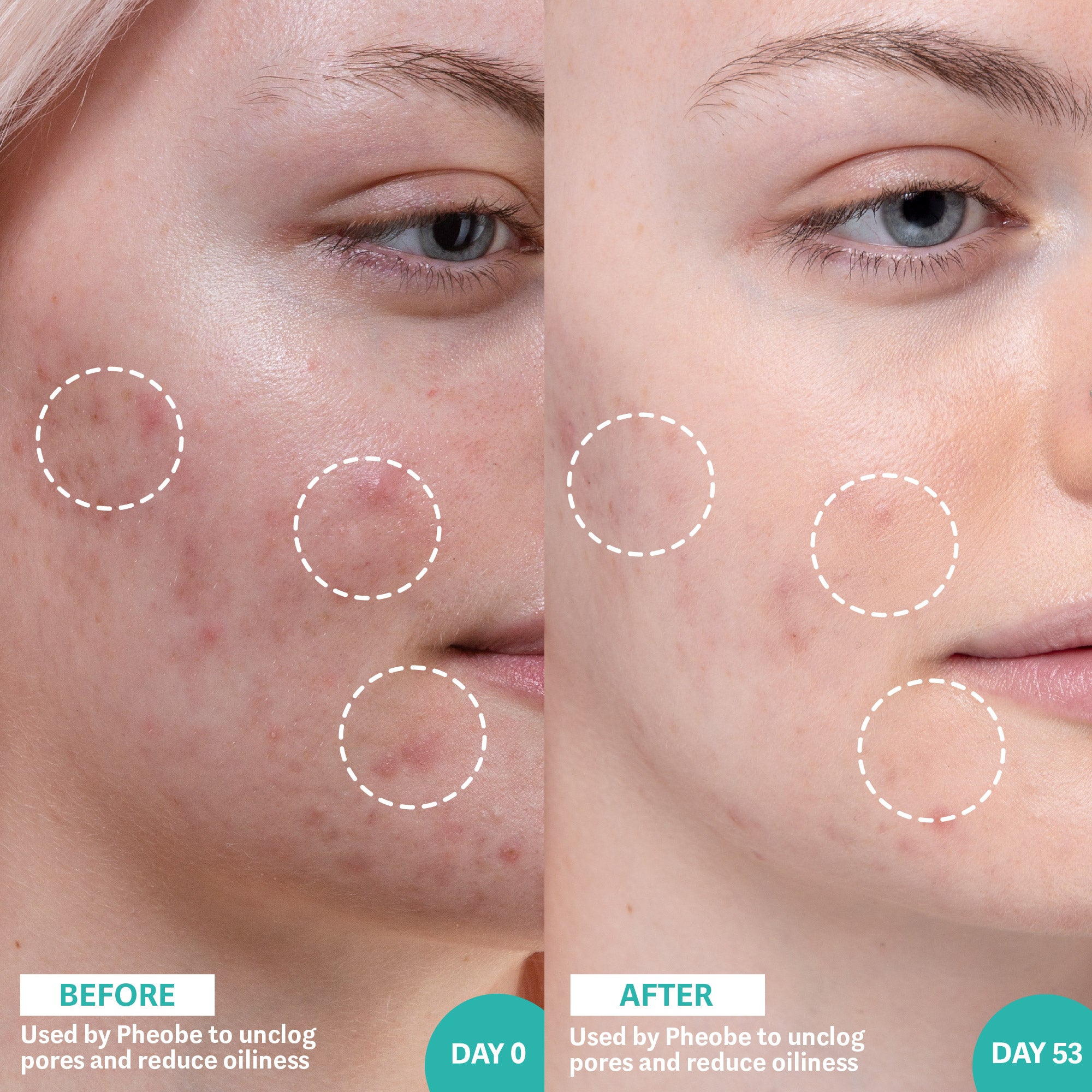 salicylic acid before and after