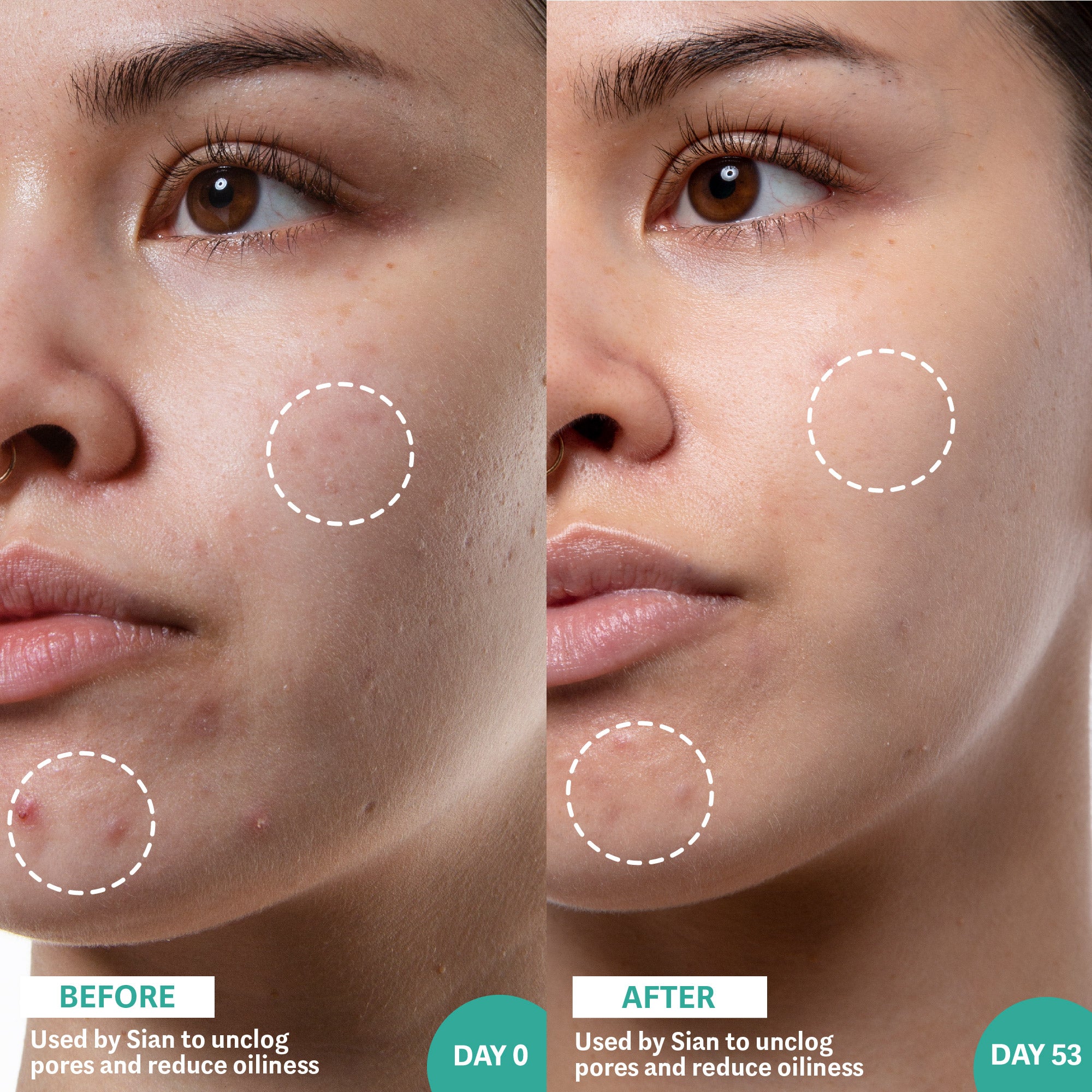 Before and after image of woman using Salicylic Acid & Sea Kelp Serum